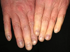 Il fumo e il suo fenomeno di Raynaud