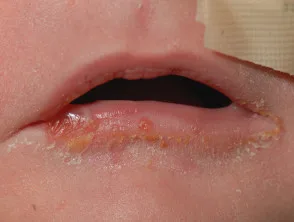 Epidermólisis ampollosa distrófica recesiva