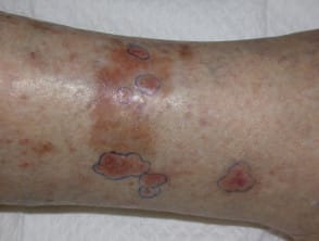 Carcinoma basocelular recurrente tras legrado y electrocirugía