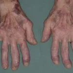 rheumatoide Hände__protectwyjqcm90zwn0il0_focusfillwzi5ncwymjisingildiwxq-1125416-2388358-jpg-7323880