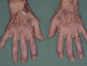 Artritis reumatoide de manos