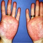 reumatoïde1__protectwyjqcm90zwn0il0_focusfillwzi5ncwymjisingildfd-3338008-2485439-jpg-7061078