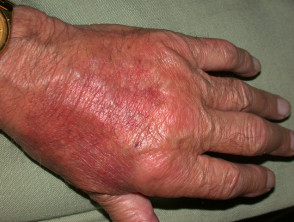Dermatosis neutrofílica asociada con artritis reumatoide