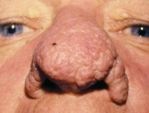 rhinophyma