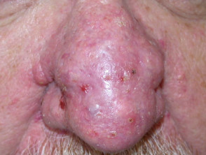 Rhinophyma