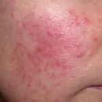 rosacea2__protectwyjqcm90zwn0il0_focusfillwzi5ncwymjisingildfd-8823757-9246079-jpg-3988888