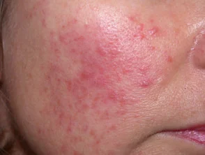 rosacea2__protectwyjqcm90zwn0il0_focusfillwzi5ncwymjisingildfd-8823757-9246079-jpg-3988888