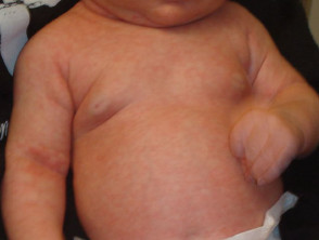 roseola-004__protectwyjqcm90zwn0il0_focusfillwzi5ncwymjisingildfd-6790863-1198880-jpg-1496479