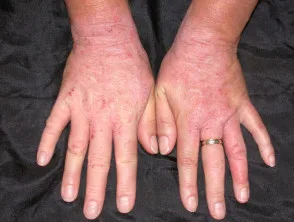 rubberen dermatitis