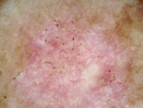 Dermatoscopia de carcinoma basocelular superficial