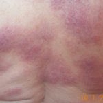 sarcoid__protectwyjqcm90zwn0il0_focusfillwzi5ncwymjisingildfd-1744211-4870291-jpg-4016894