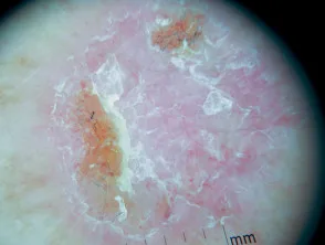 Dermoscopia superficiale del carcinoma basocellulare