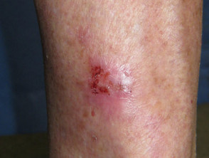 Carcinoma de células basales superficial, pierna
