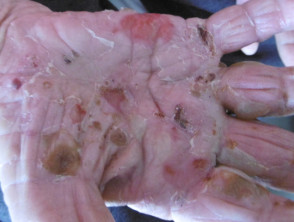 Madrigueras infectadas en sarna costrosa