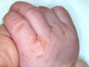 Sarna en la mano de un bebé