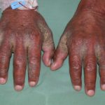 scabies-6-big__protectwyjqcm90zwn0il0_focusfillwzi5ncwymjisingildfd-6189163-5264177-jpg-3872363