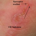 scabies27__protectwyjqcm90zwn0il0_focusfillwzi5ncwymjisinkildezxq-6232638-2113522-jpg-5314645