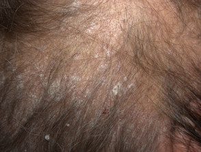 Psoriasis del cuero cabelludo
