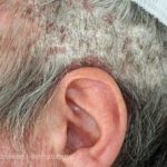 hoofdhuid-psoriasis__protectwyjqcm90zwn0il0_focusfillwzi5ncwymjisingildiyxq-5291831-7931224-jpg-7082759
