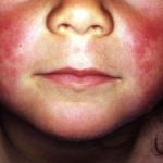 scarlet-fever__protectwyjqcm90zwn0il0_focusfillwzi5ncwymjisingildfd-1130532-7955248-jpg-1763924