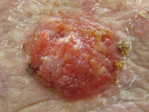 Carcinoma cutáneo de células escamosas de alto riesgo