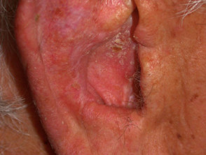 Carcinoma de células escamosas in situ
