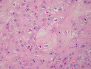 Patología del carcinoma de células escamosas