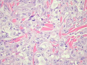 Patología del carcinoma de células escamosas poco diferenciado