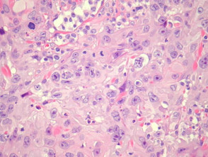 Patología del carcinoma de células escamosas pobremente diferenciado