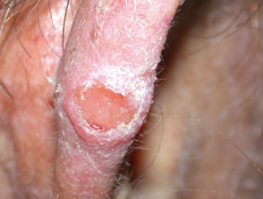 Carcinoma ulcerado de células escamosas