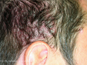 Psoriasis del cuero cabelludo