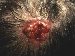 Nevus sebáceo con carcinoma de células basales