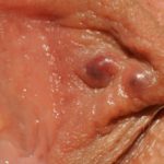 sebaceous-adenitis__protectwyjqcm90zwn0il0_focusfillwzi5ncwymjisinkildg1xq-9483715-5752238-jpg-5466082