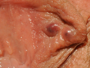 Adenitis sebácea vulvar