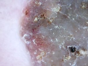 Queratosis seborreica: dermatoscopia