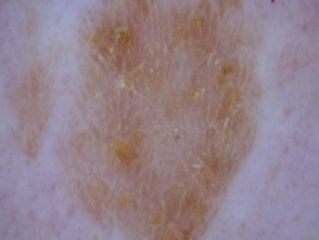 Queratosis seborreica: dermatoscopia