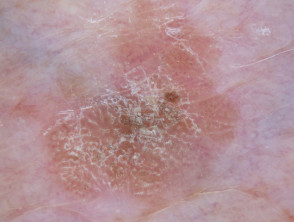 Queratosis seborreica: dermatoscopia