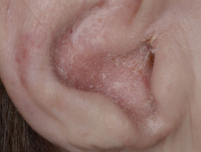 Sebopsoriasi dell'orecchio