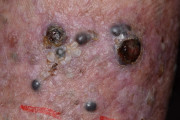 Melanoma secundario en la piel.