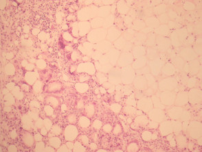 Necrosis grasa subcutánea de la patología del recién nacido.