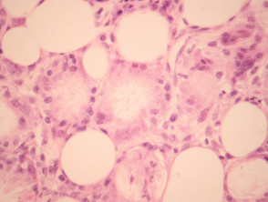Necrosis grasa subcutánea de la patología del recién nacido.