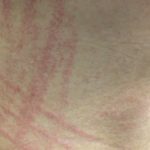 shiitake-flagellate-erythema-06__protectwyjqcm90zwn0il0_focusfillwzi5ncwymjisingildfd-7018751-4870087-jpg-3939112