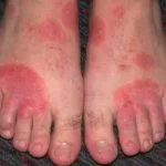 shoe-dermatitis1__protectwyjqcm90zwn0il0_focusfillwzi5ncwymjisingildfd-7130697-3924134-jpg-9881043