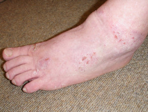 Dermatitis del calzado