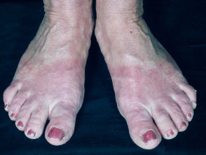 Dermatitis del calzado