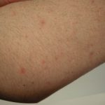 sirolimus-1__protectwyjqcm90zwn0il0_focusfillwzi5ncwymjisingildfd-2429936-7225760-jpg-1084751