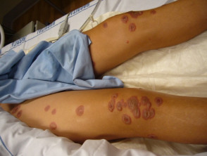 Lesiones diana asociadas con la infección por micoplasma