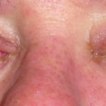 sjs-ten-ocular-18__protectwyjqcm90zwn0il0_focusfillwzi5ncwymjisingilde5nl0-4573688-1451058-jpg-3218731