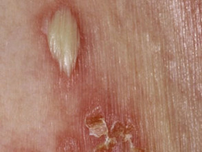 Dermatosis pustulosa subcorneal