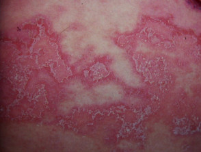 Subcorneale pustuleuze dermatose